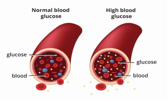 Finding Ways to Manage Blood Sugar More Effectively – PubNavigator